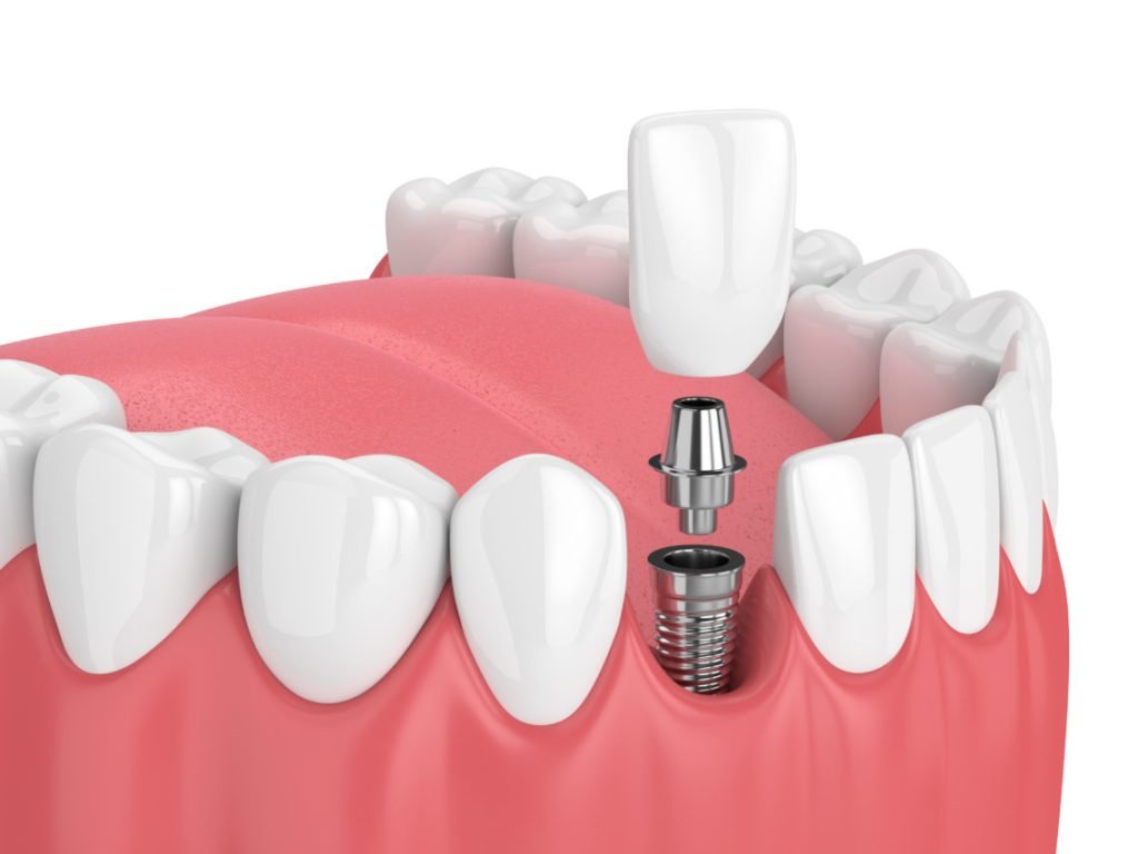 Affordable Dental Implants: The Ultimate Guide to Saving Money